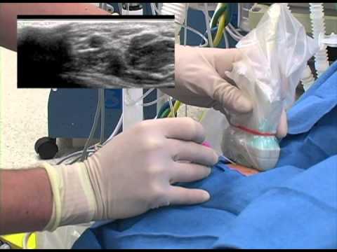 Ultrasound-guided arterial line Placement