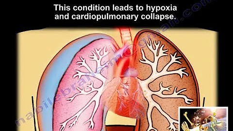 Tension Pneumothorax - Everything You Need To Know - Dr. Nabil Ebraheim