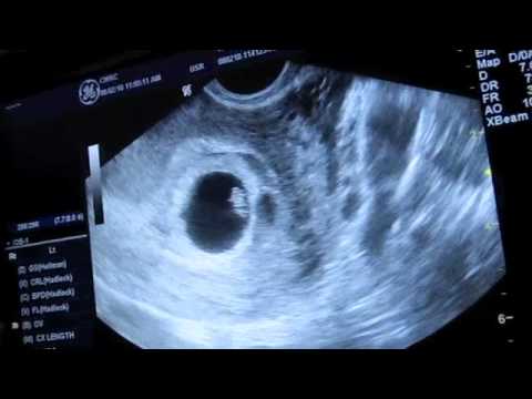 My first ultrasound with 7week twins!!