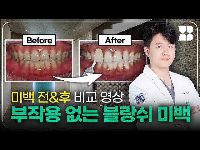 치아미백 전후비교, 미백과정부터 실제 미백후기까지!