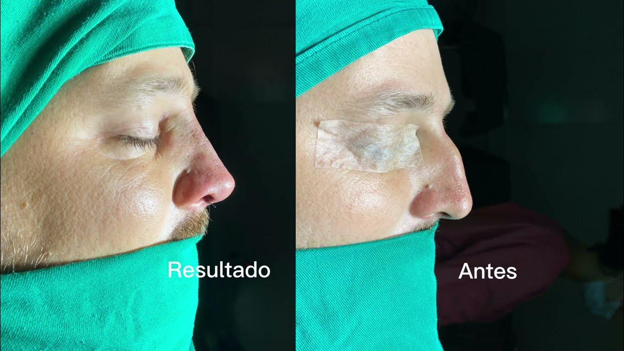RINOPLASTIA (ANTES E DEPOIS) Rinoplastia + Otoplastia masculina - YouTube