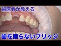 ダイレクトブリッジ２　ほぼノーカット