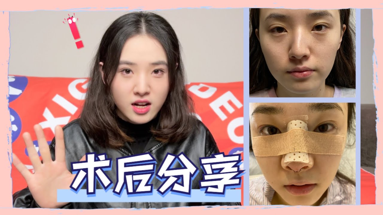 鼻中隔偏曲 歪鼻矫正半年成果分享鼻子终于恢复 正 常了 Youtube