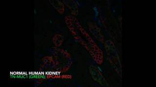 CAR t cell modification CRISPR Cas 9