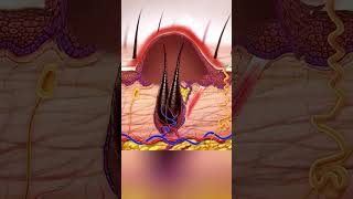 Ingrown hair removal medical animation 3D #ingrownhair #ingrownhairremoval #hairremoval