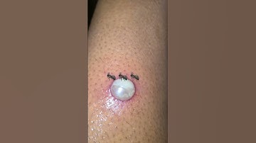 Thumbnail of #viral #viralvideo #shortvideo #fireants #ants #bite #shorts
