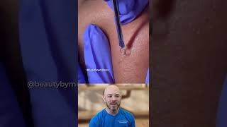Massive Chin Abscess Drainage #skincare #medical