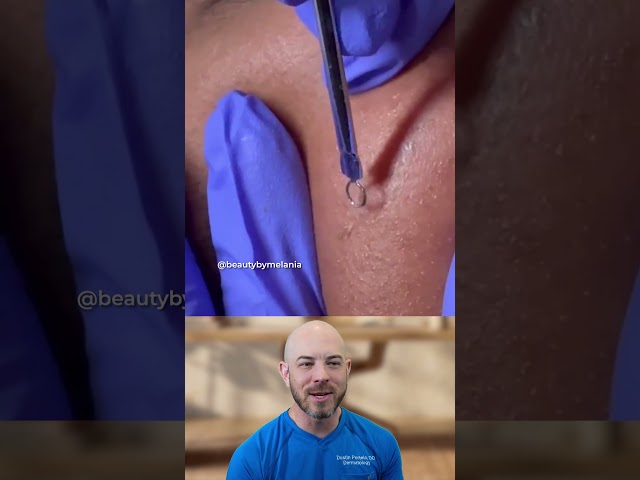 Massive Chin Abscess Drainage #skincare #medical