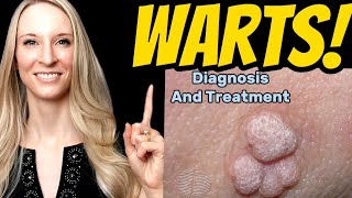 WARTS! Diagnosis, Treatment, Home Remedies. Tips from a dermatologist