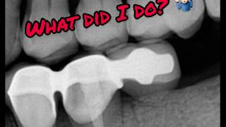 Fractured DENTAL BRIDGE! What did I do?