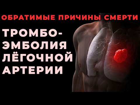 Тромбоэмболия лёгочной артерии как обратимая причина клинической смерти #ПроСМП