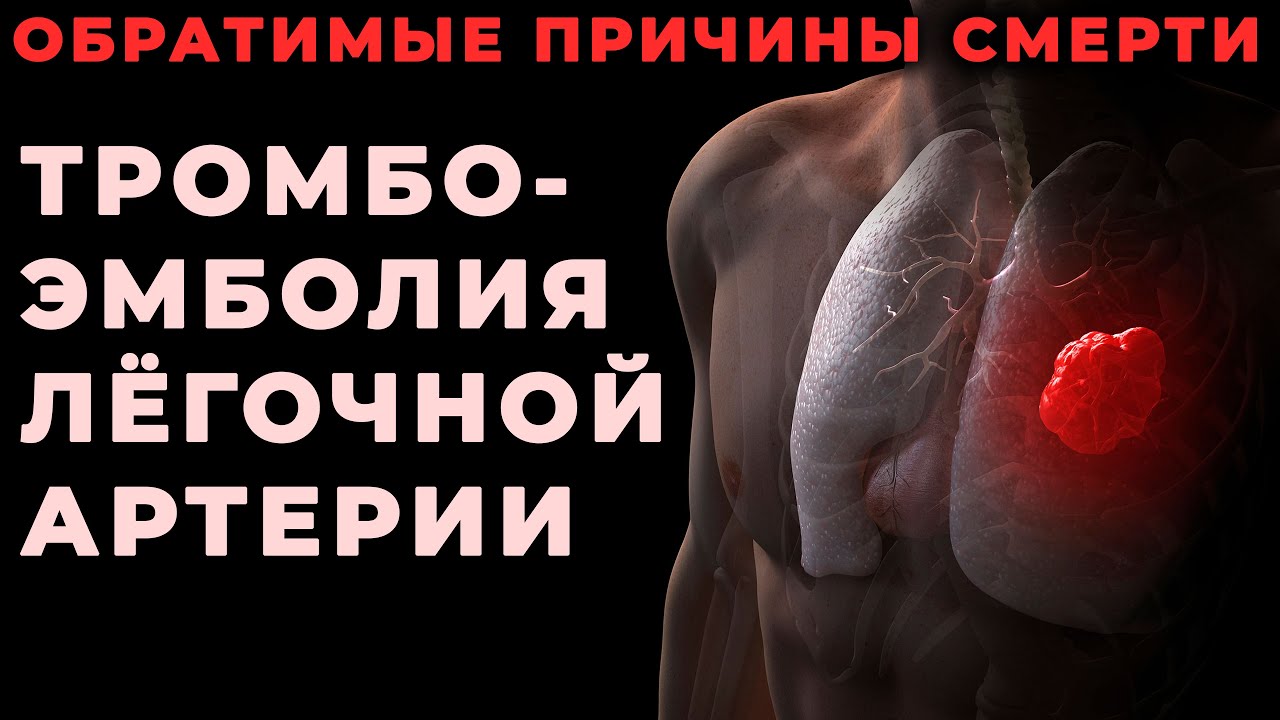 Тромбоэмболия лёгочной артерии как обратимая причина клинической смерти #ПроСМП