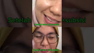 Download Lagu Hasil Laser Fractional CO2 Mix Subsisi | Cara menghilangkan bopeng bekas jerawat | Samarkan bopeng MP3