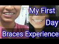 First Day Braces journey experience ,Metal Braces, पहला दिन दातो के तार का अनुभव