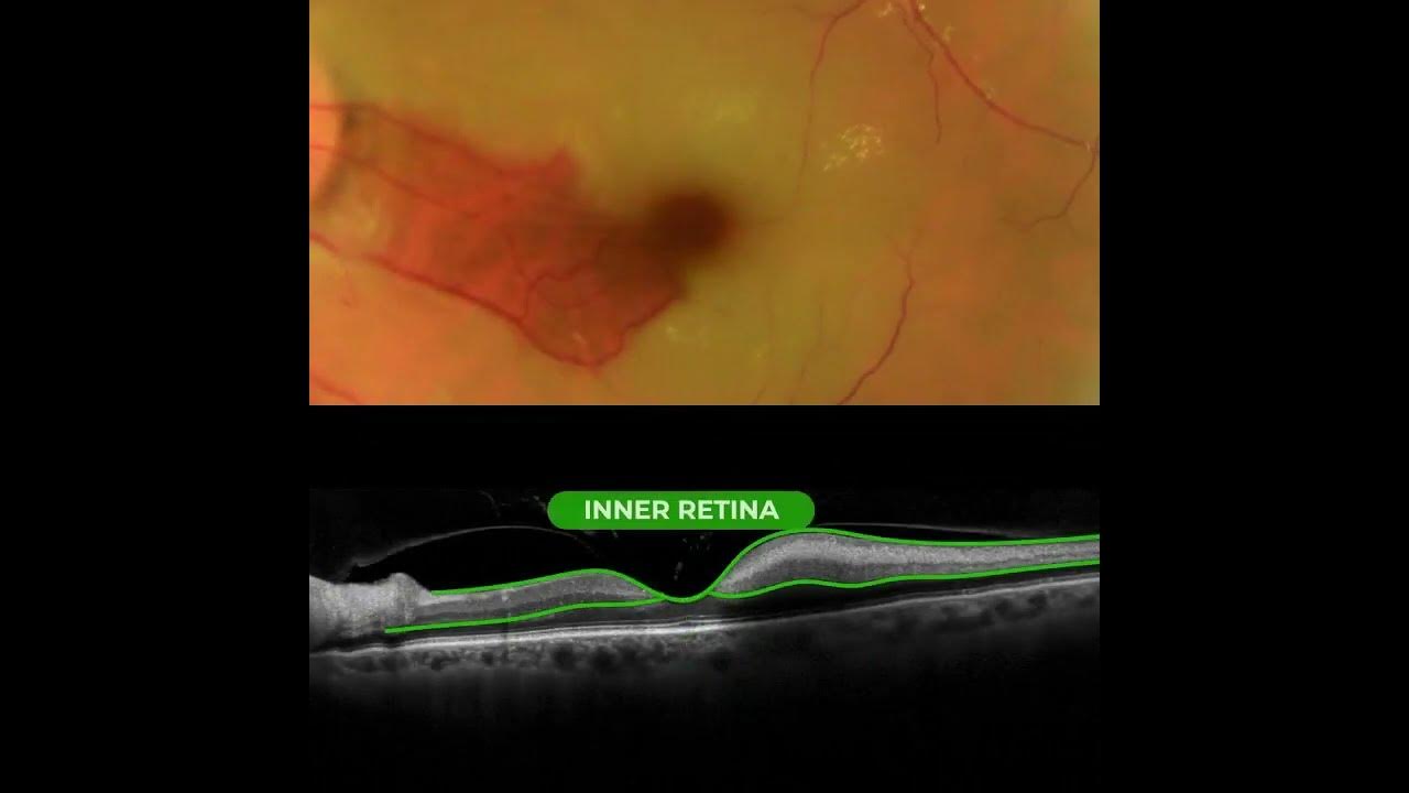 #retina #oftalmo #ophthalmology #oftalmologia #oftalmología # .