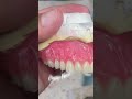 Nice and simple denture #art#dental#fyp#shorts#ytshorts#music#selfmade#cesar#dentaltechnician#tech
