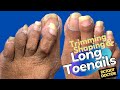 Trimming and Shaping Long Overdue for clipping Toenails (90 year old Needing Help with her Toenails)