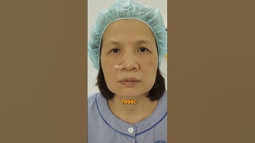 Cắt mí rồi có bị sụp lại và nếu sụp thì cắt mí tiếp được không ? | Dr Hùng Thanh