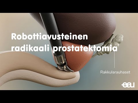Video: Mikä on radikaali prostatektomia?
