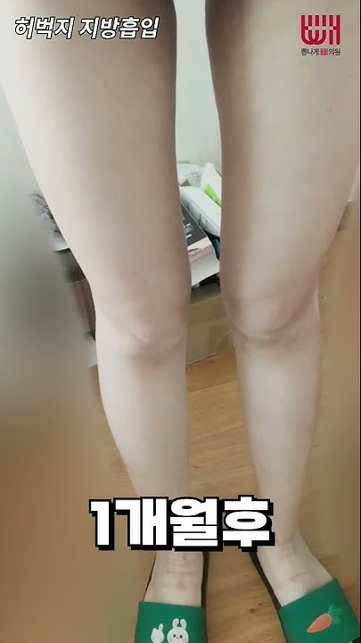 종아리부터 허벅지까지 지방흡입