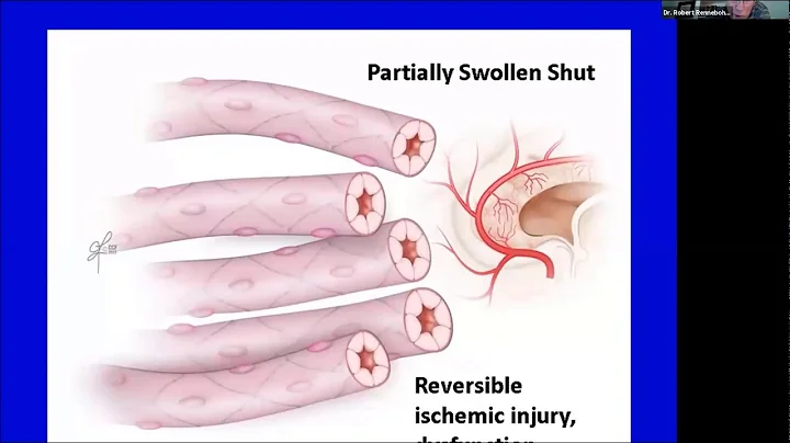 Lecture: Susac Syndrome: A Rare, but Important and Instructive Ophthalmologic Disease - DayDayNews