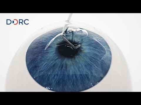 Video: Histopathologie Van Een Retrocorneale Membraan Na Descemet-membraan-endotheliale Keratoplastie: Een Casusrapport