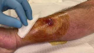 spiderbite to the arm