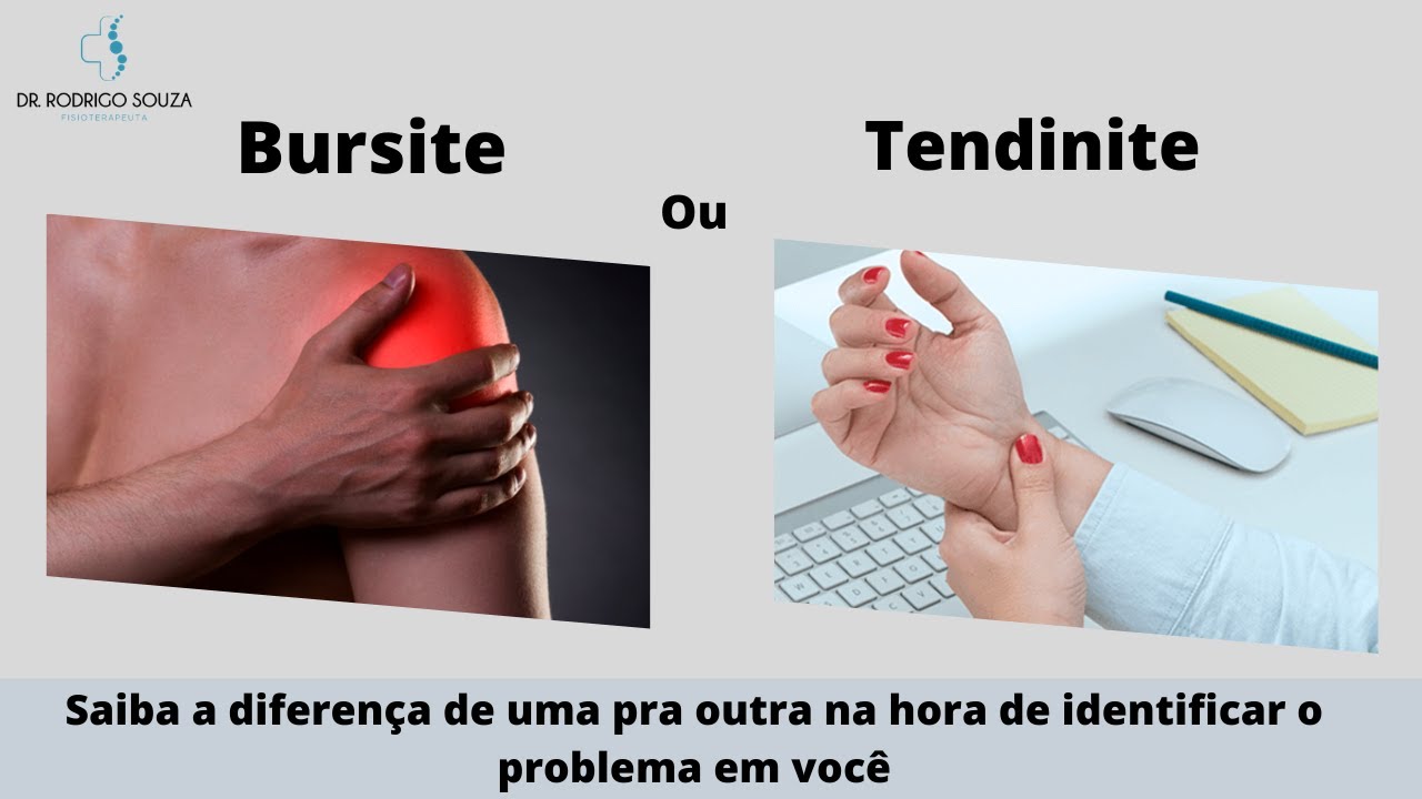 Qual A Diferença Entre Bursite E Tendinite – AUHG