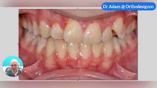 Custom KLOwen Braces and Efficiency for the Health of Teeth