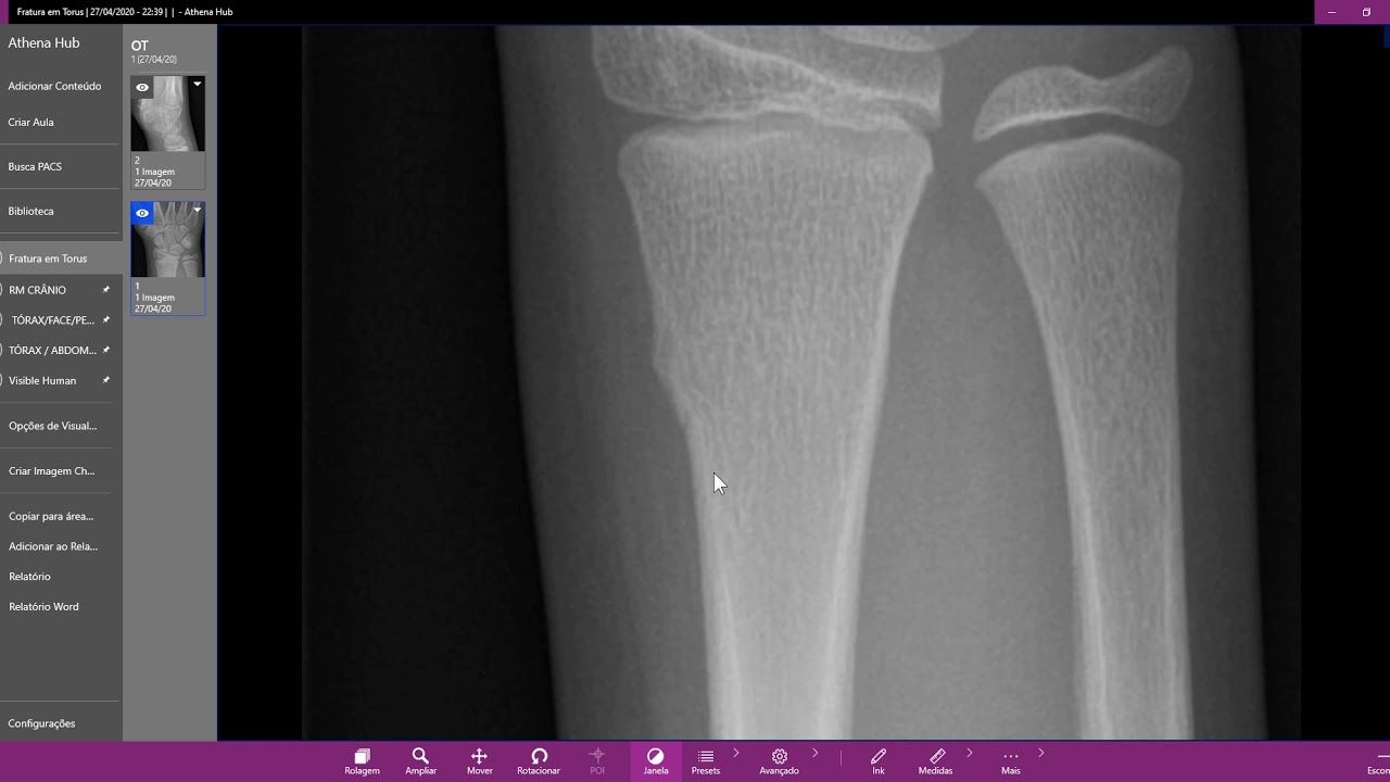 Fratura Em Torus Youtube