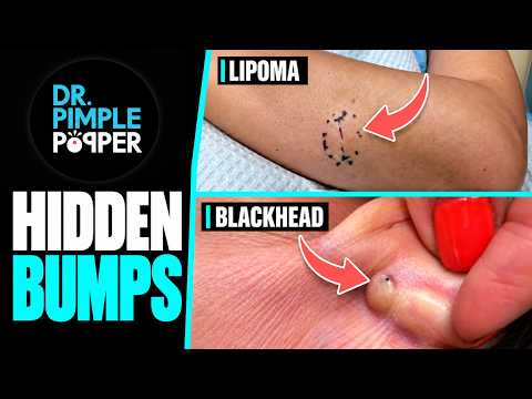 Dr. Pimple Popper vs. Two Hidden Bumps