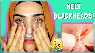 How To REMOVE BLACKHEADS + WHITEHEADS Instantly! ~ Immy