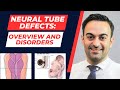 Neural tube defects overview and defects