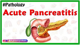 Acute Pancreatitis: Etiology , signs and Symptoms, pathophysiology , Diagnosis, Treatment