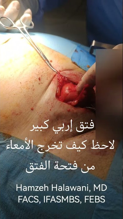 شاهد الفتق الاربي اثناء العملية | الدكتور حمزة الحلواني