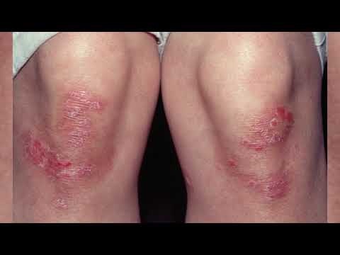 Psoriasis: photos of the initial stage on the hands, legs, body and head