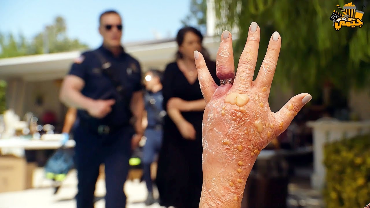 حطت خاتم  في صباعها والصدمة عندها حساسية ومتعرفش .. والمرعب حصلت كارثة في ايدها كلها