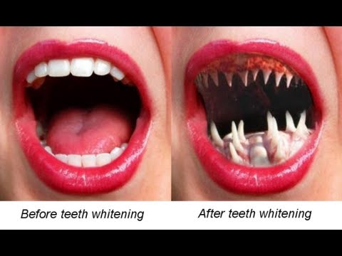 Warning!! Dangers of Teeth Whitening Products - YouTube