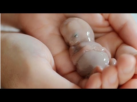 اسباب واعراض الاجهاض فى الشهر الاول من الحمل Youtube