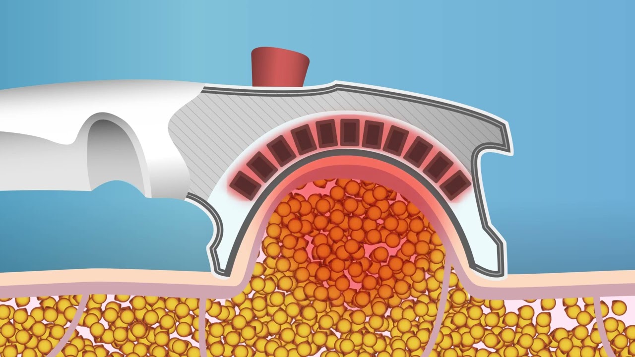 Cryolipolyse CryoSlim by France Cryo