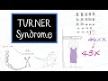 What is Turner Syndrome?