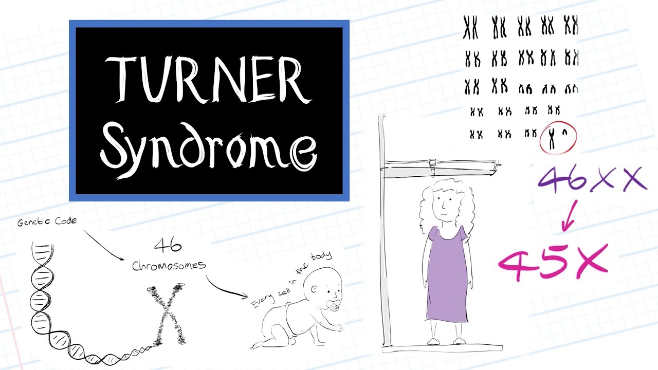 Turner Syndrome Pedigree Chart