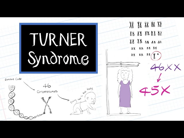 What is Turner Syndrome? (HealthSketch) class=