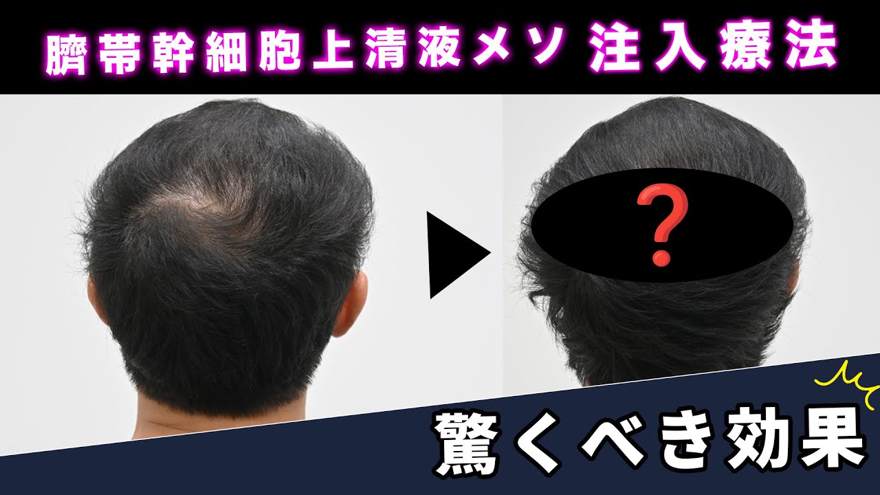 【薄毛治療】注入療法の効果で髪の毛に変化が!!!