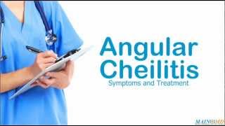 Angular Cheilitis ¦ Treatment and Symptoms