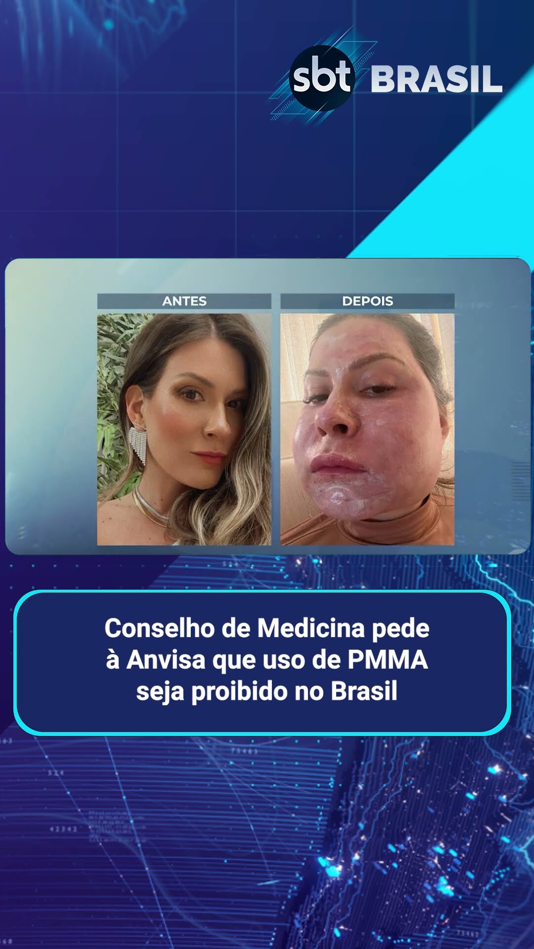 Conselho de Medicina pede à Anvisa que uso de PMMA seja proibido no Brasil | SBT Brasil (22/01/25)