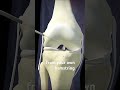 How ACL Surgery is Performed?（3DAnimation）#how #acl #aclsurgery #aclrecovery #surgery #surgeon