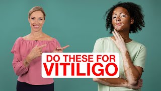 7 TIPS to Help VITILIGO | Dr. Janine