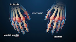 How Is Rheumatoid Arthritis Treated? - Manipal Hospitals