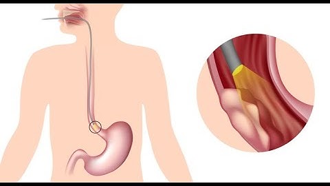 Esophagoscopy CPT code - simplify medical coding